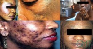 Santé publique au Bénin : l’ABMed interdit la vente de 12 produits cosmétiques dépigmentants dangereux