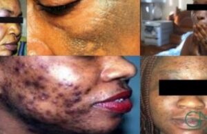 Santé publique au Bénin : l’ABMed interdit la vente de 12 produits cosmétiques dépigmentants dangereux